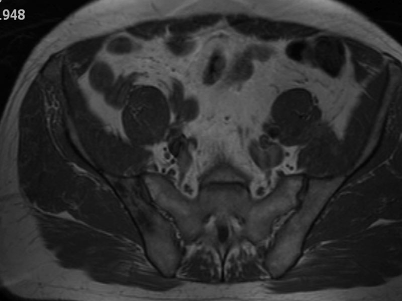 Fig 4. Axial MRI showing signal change to the sacroiliac joint